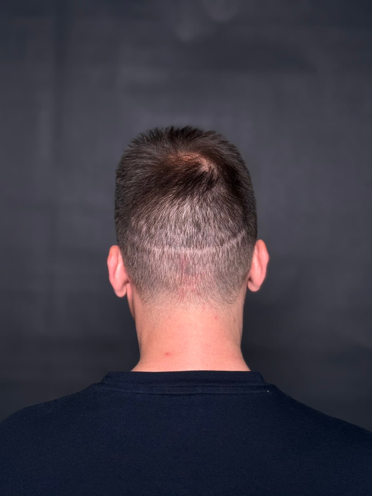 smp scalp micro pigmentation αραίωση φαλάκρα hair ουλή εγχείριση transplant fut fue