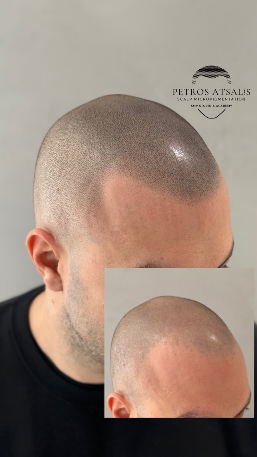 smp scalp micro pigmentation αραίωση φαλάκρα hair