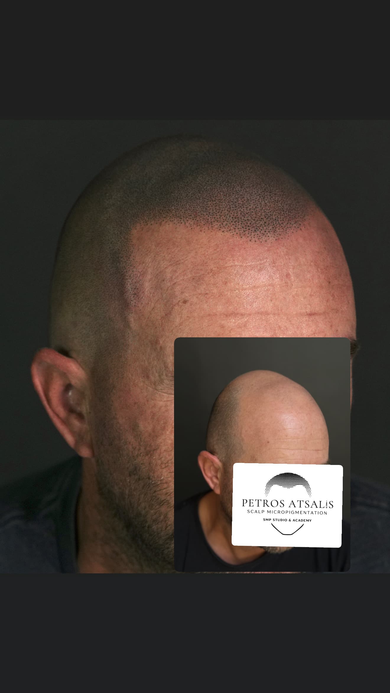 Smp scalpmicropigmentation hairtattoo transplant αραιωση φαλακρα αλωπεκια hairloss