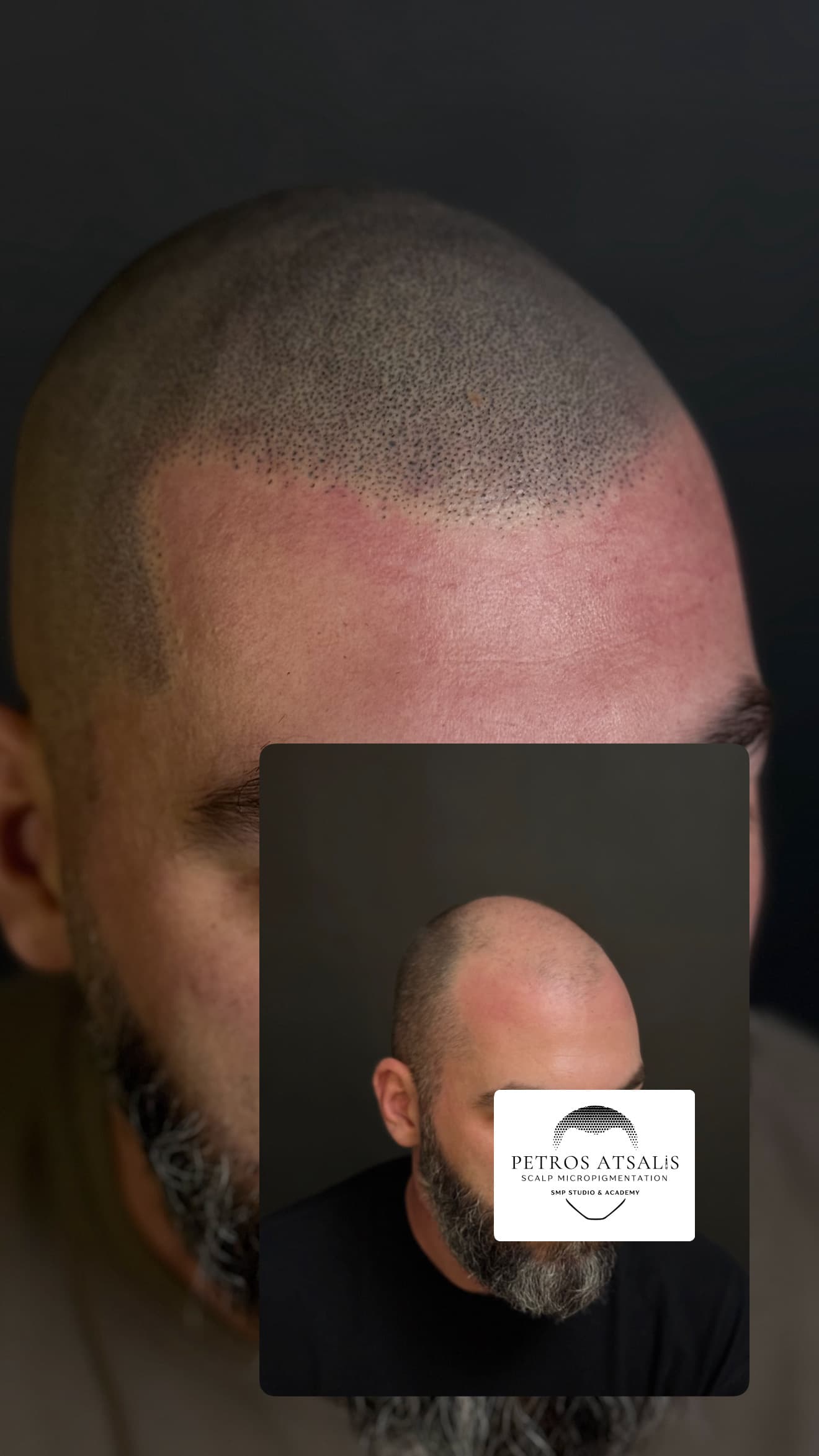 Smp scalpmicropigmentation hairtattoo transplant αραιωση φαλακρα αλωπεκια hairloss